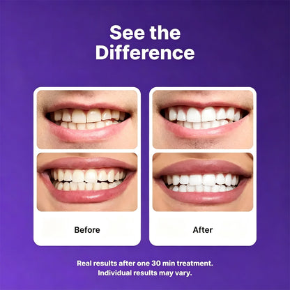 Purple Teeth Whitening Strips