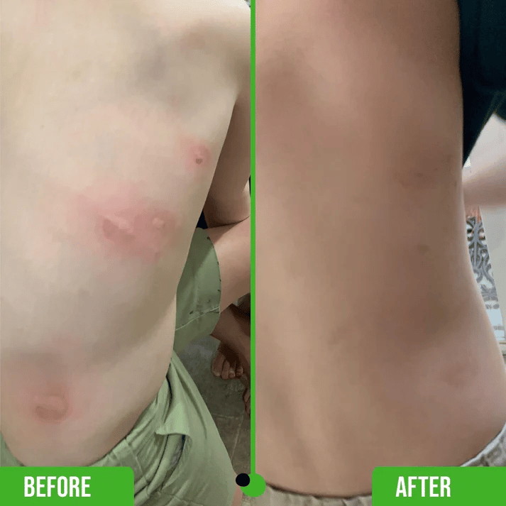 2025 - Bug Bite Thing Insect Bite and Sting Suction Tool